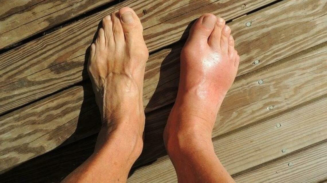 Uric Acid: Essential diet tips for gout patients - Zanskar