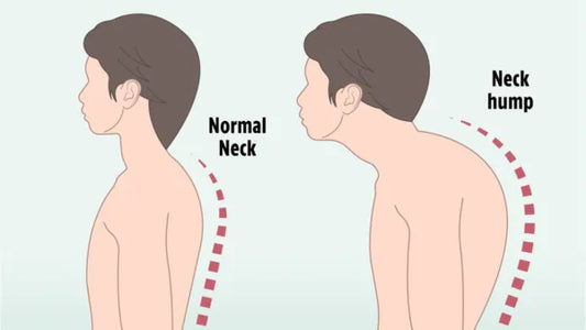 What causes a hump on the back of the neck, also known as Buffalo Hump?