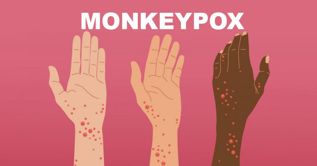 Monkeypox in India: Body Pain Symptoms and How to Prevent?