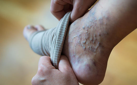Varicose Veins: Should You Use Heat or Cold?